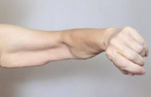 Sarcopenia: Causes of Muscle Loss and Solutions