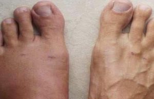 Swollen feet: a sign you shouldn’t ignore