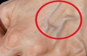 Natural Remedies to Improve the Health of Your Veins and Skin