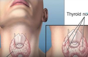 Wa.rning: These 2 Supplements Could Accelerate Thyroid Ca.ncer