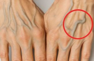 What causes veins to be more visible in hands at young age