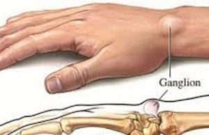 Lumps on the hands: here’s what you should know about them